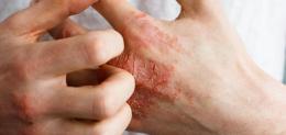 eczema-on-hand