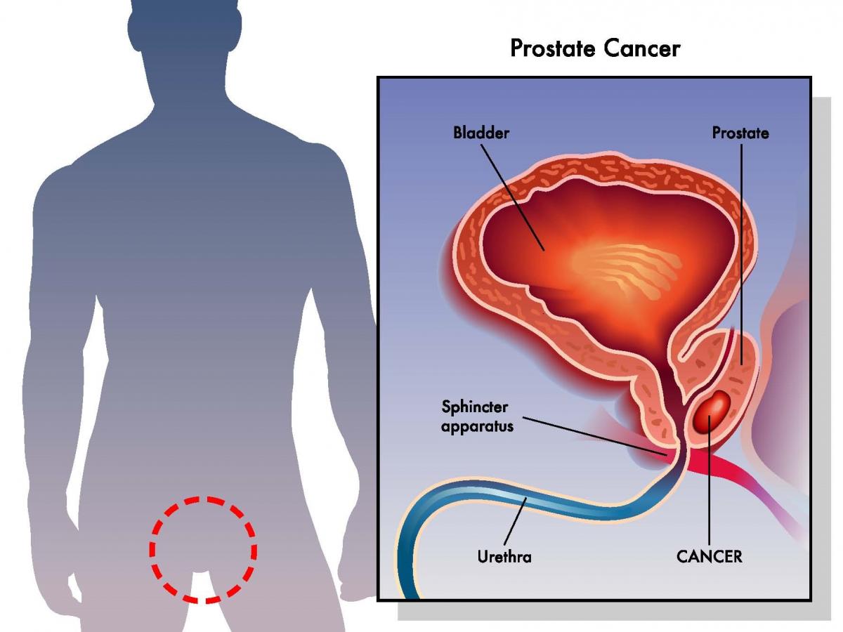 What Is Prostate Cancer