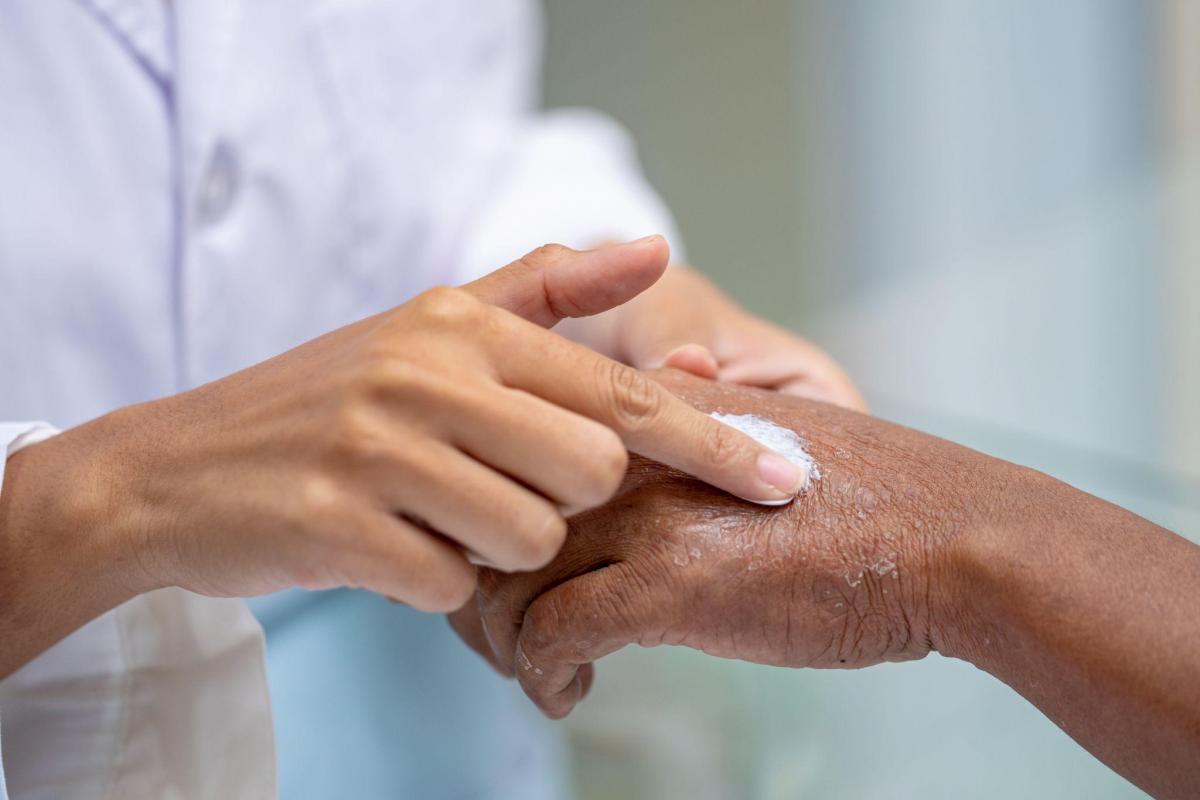 Doctor hand apply steroid moisturizer cream on old man hand with flaking dry itchy skin