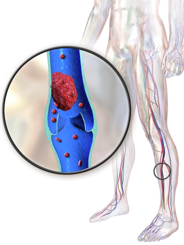 DVT Blood clot