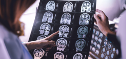 brain-atrophy-on-mri-of-dementia-patient