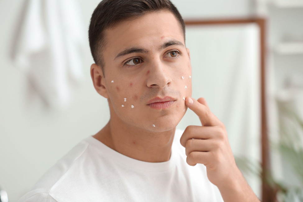 young man using remedy for acne at home